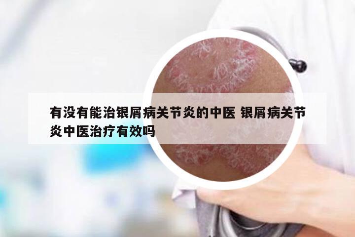 有没有能治银屑病关节炎的中医 银屑病关节炎中医治疗有效吗