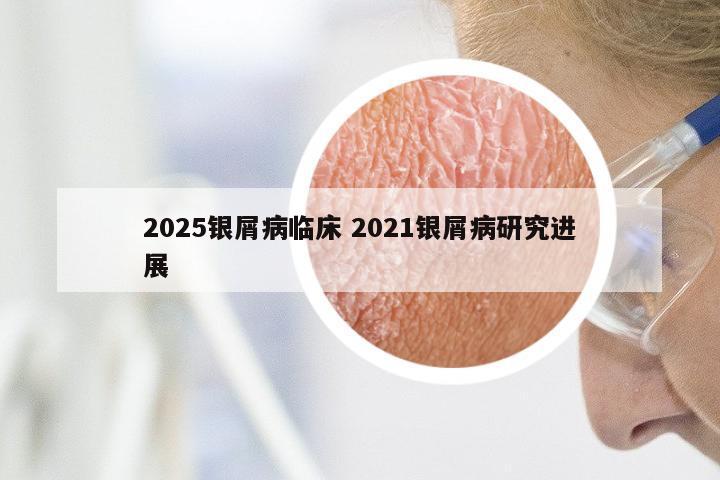 2025银屑病临床 2021银屑病研究进展