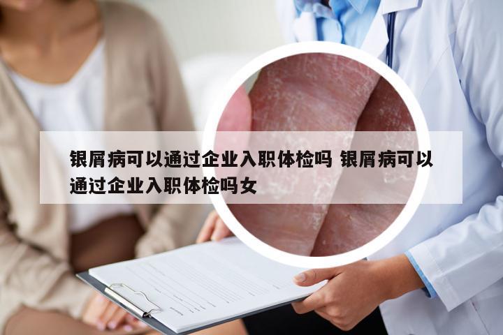 银屑病可以通过企业入职体检吗 银屑病可以通过企业入职体检吗女