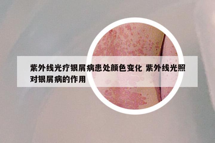 紫外线光疗银屑病患处颜色变化 紫外线光照对银屑病的作用