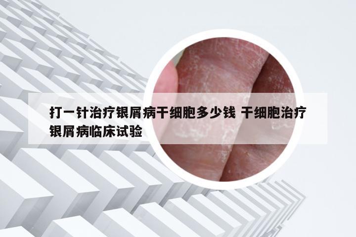 打一针治疗银屑病干细胞多少钱 干细胞治疗银屑病临床试验