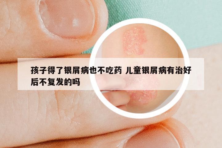 孩子得了银屑病也不吃药 儿童银屑病有治好后不复发的吗