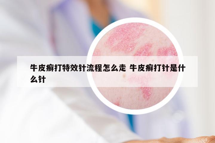 牛皮癣打特效针流程怎么走 牛皮癣打针是什么针