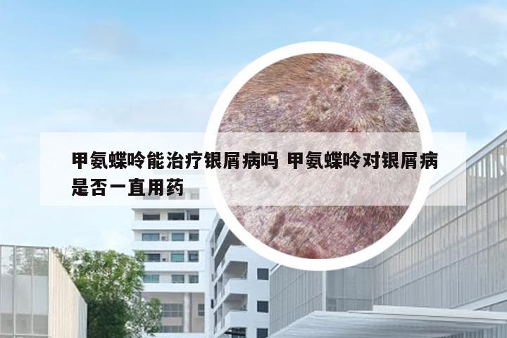 甲氨蝶呤能治疗银屑病吗 甲氨蝶呤对银屑病是否一直用药
