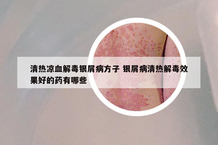 清热凉血解毒银屑病方子 银屑病清热解毒效果好的药有哪些
