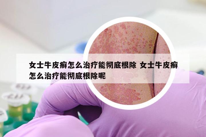 女士牛皮癣怎么治疗能彻底根除 女士牛皮癣怎么治疗能彻底根除呢