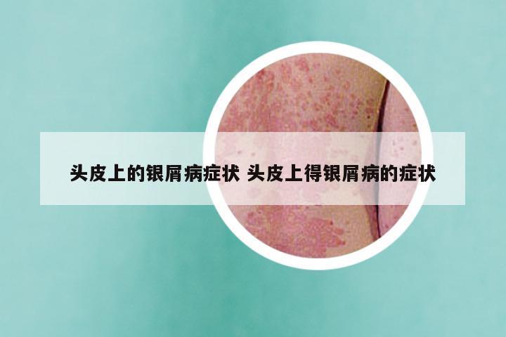 头皮上的银屑病症状 头皮上得银屑病的症状