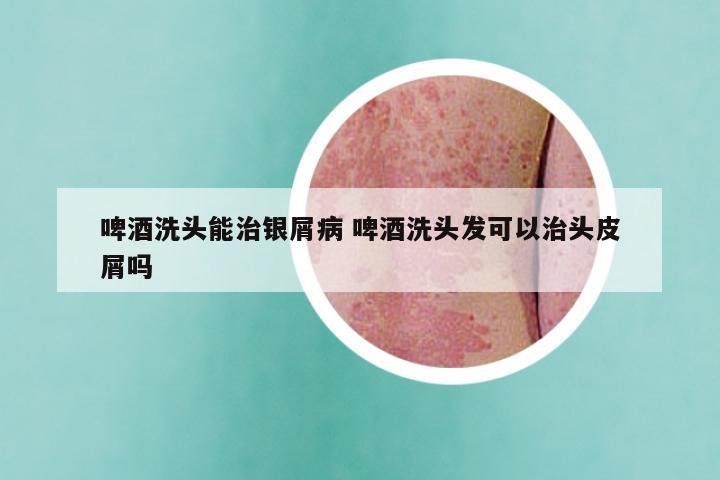 啤酒洗头能治银屑病 啤酒洗头发可以治头皮屑吗