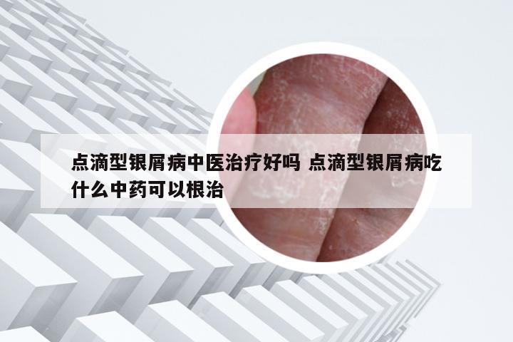 点滴型银屑病中医治疗好吗 点滴型银屑病吃什么中药可以根治