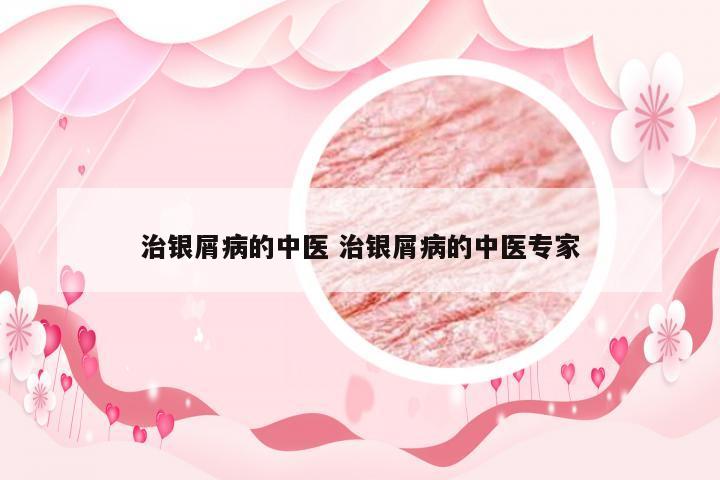 治银屑病的中医 治银屑病的中医专家