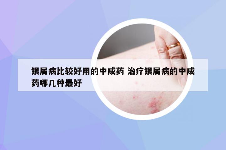 银屑病比较好用的中成药 治疗银屑病的中成药哪几种最好