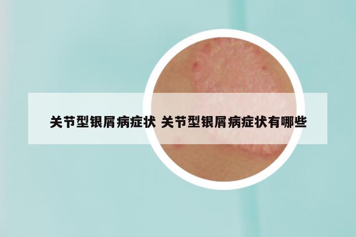 关节型银屑病症状 关节型银屑病症状有哪些