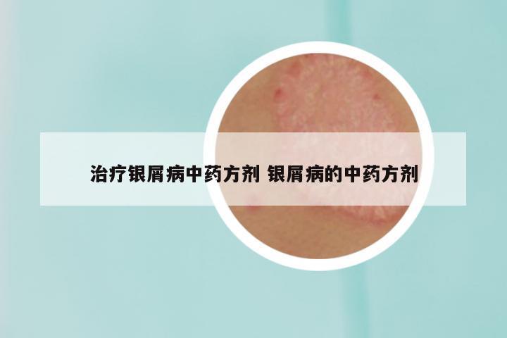 治疗银屑病中药方剂 银屑病的中药方剂