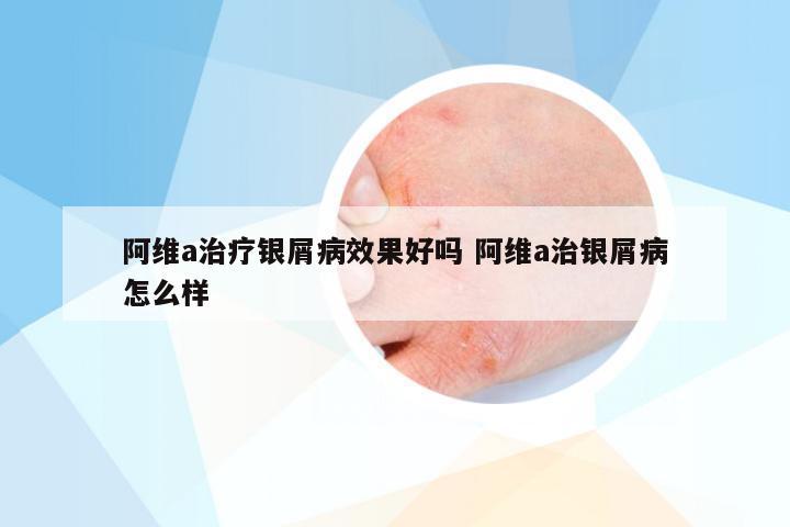 阿维a治疗银屑病效果好吗 阿维a治银屑病怎么样