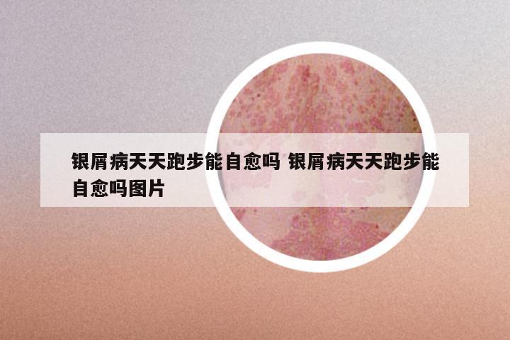 银屑病天天跑步能自愈吗 银屑病天天跑步能自愈吗图片