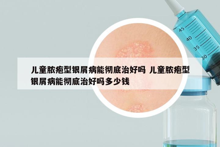 儿童脓疱型银屑病能彻底治好吗 儿童脓疱型银屑病能彻底治好吗多少钱