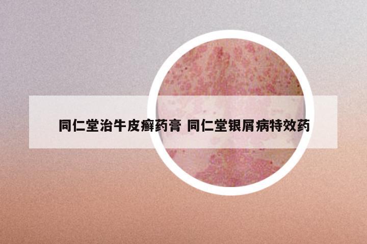 同仁堂治牛皮癣药膏 同仁堂银屑病特效药