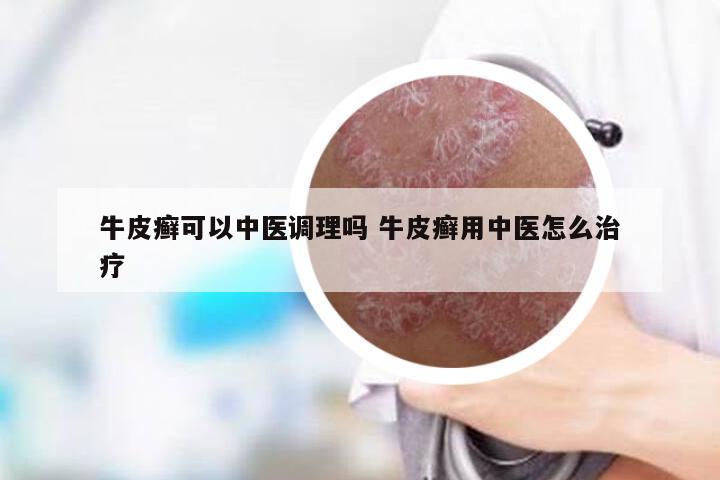 牛皮癣可以中医调理吗 牛皮癣用中医怎么治疗