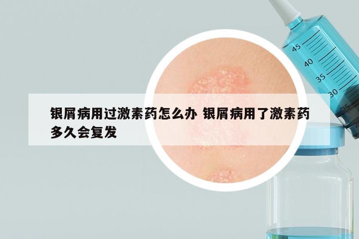 银屑病用过激素药怎么办 银屑病用了激素药多久会复发