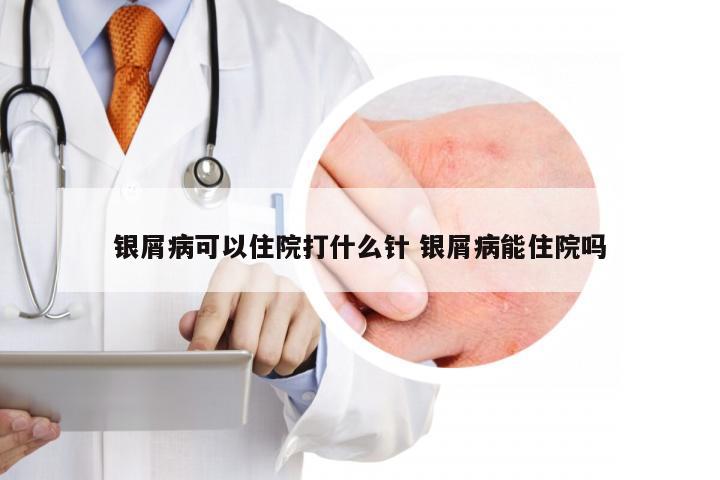 银屑病可以住院打什么针 银屑病能住院吗