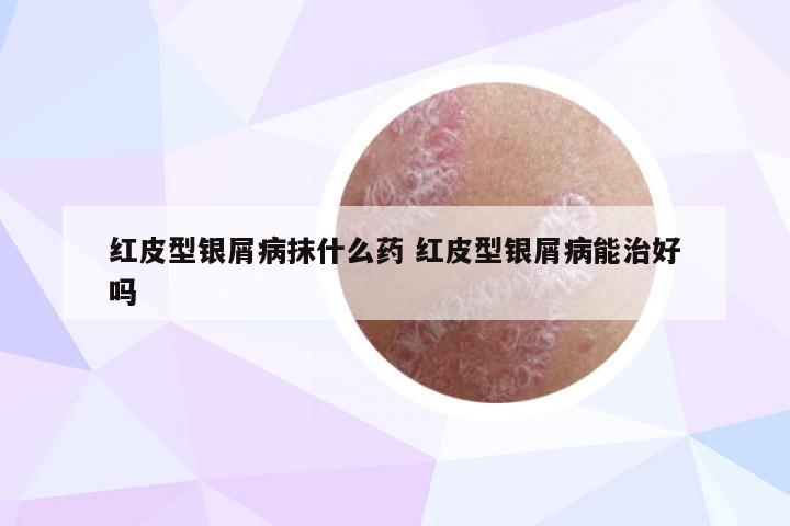 红皮型银屑病抹什么药 红皮型银屑病能治好吗