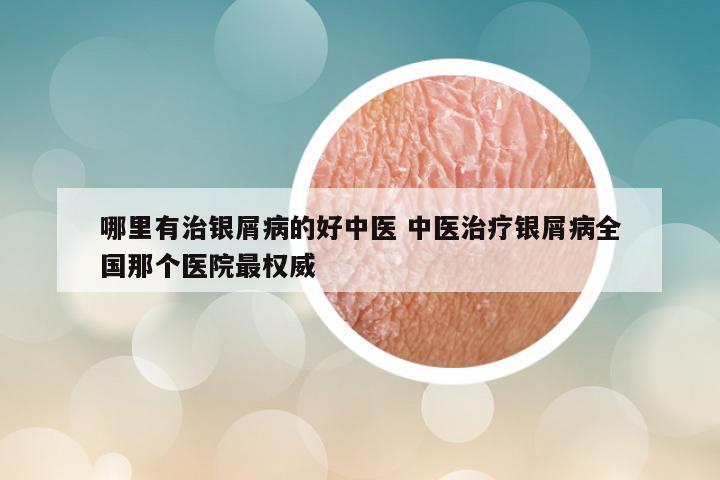 哪里有治银屑病的好中医 中医治疗银屑病全国那个医院最权威