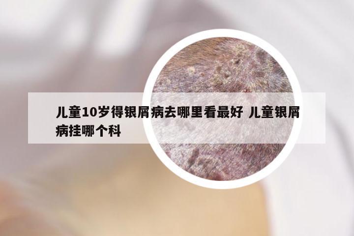 儿童10岁得银屑病去哪里看最好 儿童银屑病挂哪个科