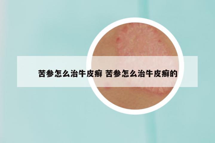 苦参怎么治牛皮癣 苦参怎么治牛皮癣的