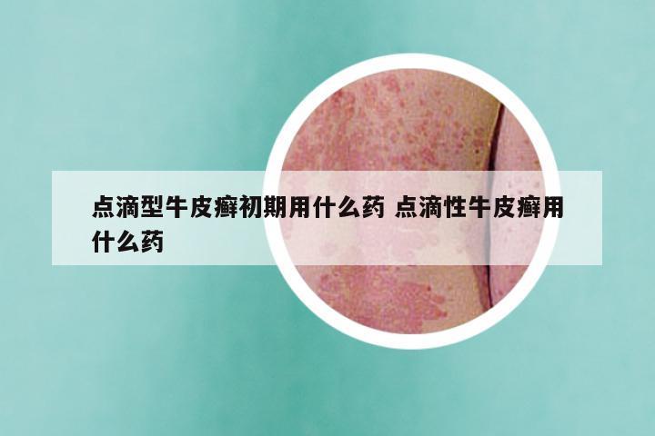 点滴型牛皮癣初期用什么药 点滴性牛皮癣用什么药