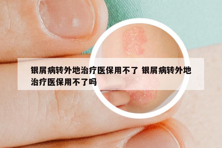 银屑病转外地治疗医保用不了 银屑病转外地治疗医保用不了吗