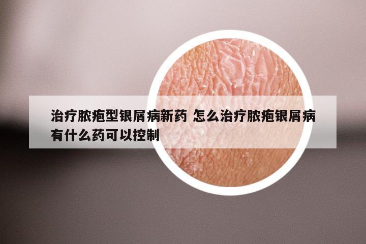治疗脓疱型银屑病新药 怎么治疗脓疱银屑病有什么药可以控制