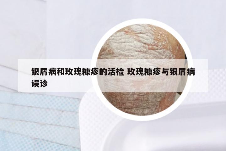 银屑病和玫瑰糠疹的活检 玫瑰糠疹与银屑病误诊