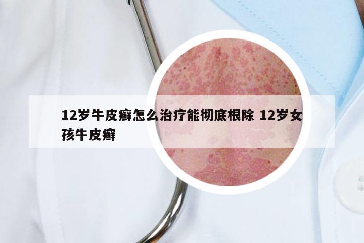 12岁牛皮癣怎么治疗能彻底根除 12岁女孩牛皮癣
