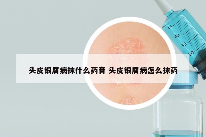 头皮银屑病抹什么药膏 头皮银屑病怎么抹药