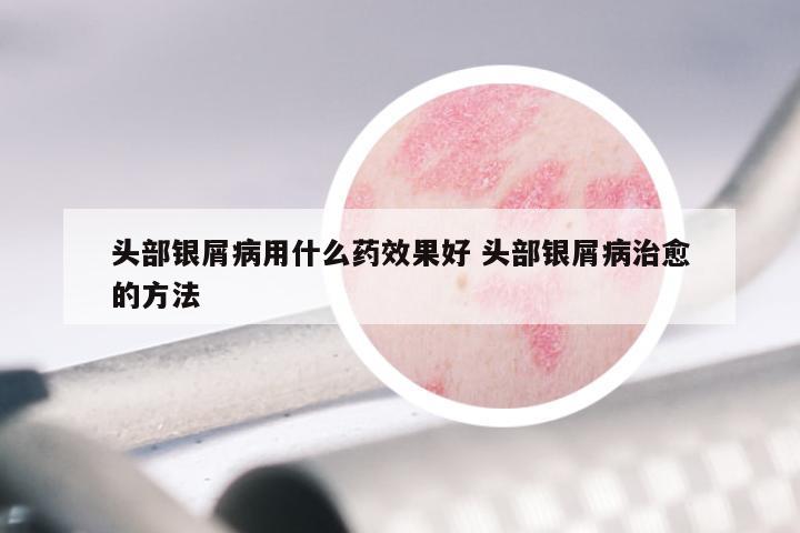 头部银屑病用什么药效果好 头部银屑病治愈的方法