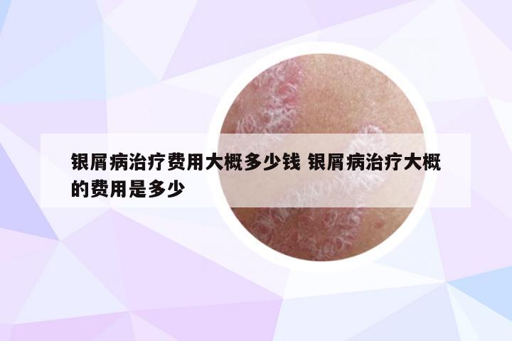 银屑病治疗费用大概多少钱 银屑病治疗大概的费用是多少
