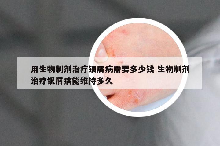 用生物制剂治疗银屑病需要多少钱 生物制剂治疗银屑病能维持多久