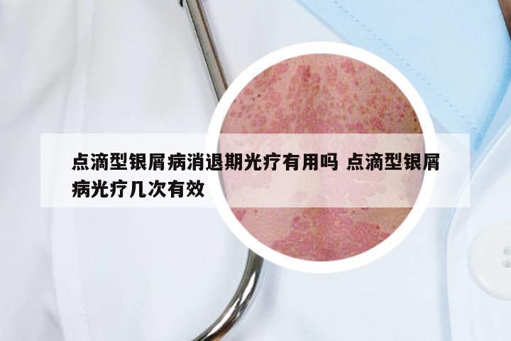 点滴型银屑病消退期光疗有用吗 点滴型银屑病光疗几次有效