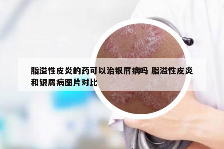 脂溢性皮炎的药可以治银屑病吗 脂溢性皮炎和银屑病图片对比