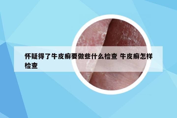 怀疑得了牛皮癣要做些什么检查 牛皮癣怎样检查