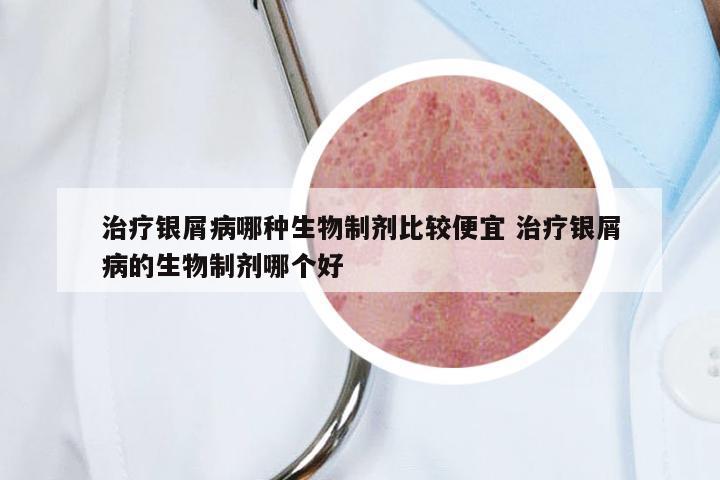 治疗银屑病哪种生物制剂比较便宜 治疗银屑病的生物制剂哪个好