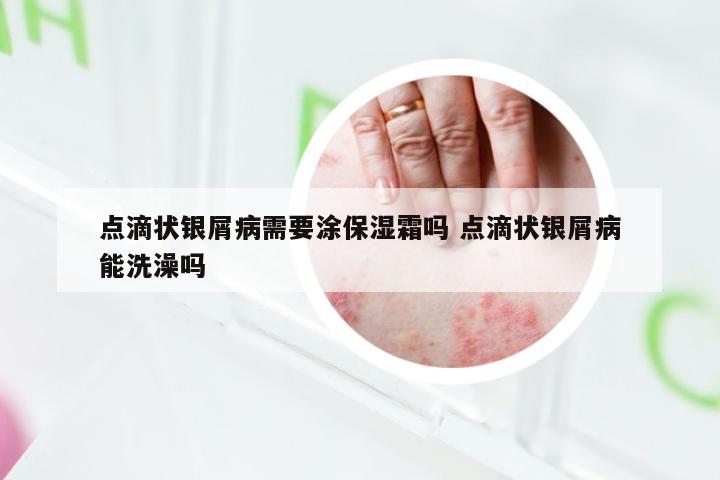 点滴状银屑病需要涂保湿霜吗 点滴状银屑病能洗澡吗