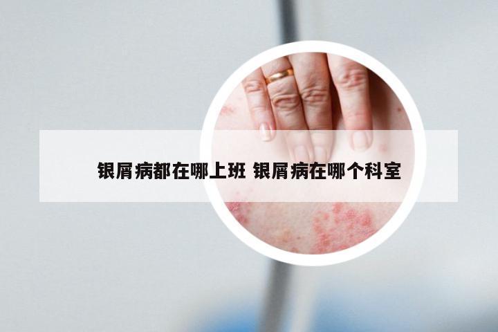 银屑病都在哪上班 银屑病在哪个科室