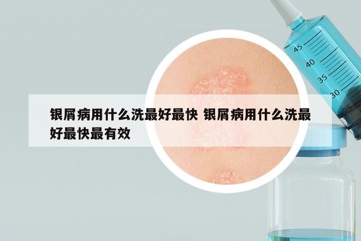 银屑病用什么洗最好最快 银屑病用什么洗最好最快最有效