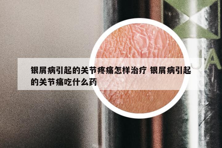银屑病引起的关节疼痛怎样治疗 银屑病引起的关节痛吃什么药
