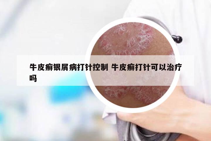 牛皮癣银屑病打针控制 牛皮癣打针可以治疗吗