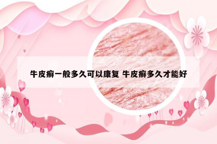 牛皮癣一般多久可以康复 牛皮癣多久才能好