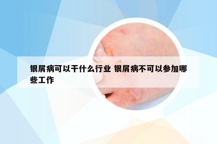 银屑病可以干什么行业 银屑病不可以参加哪些工作