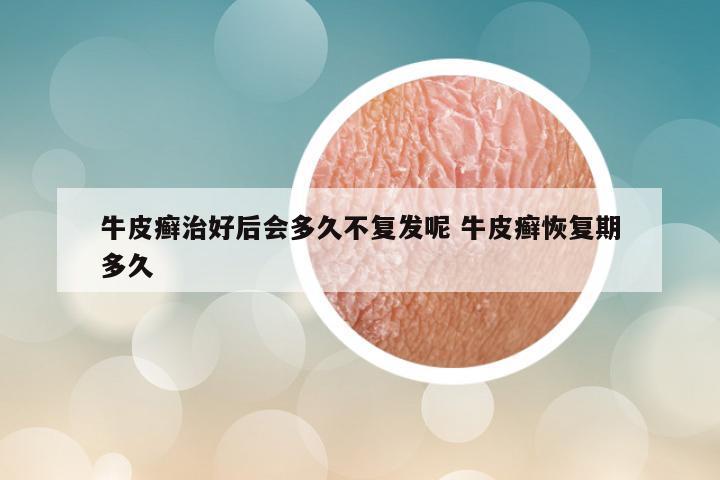 牛皮癣治好后会多久不复发呢 牛皮癣恢复期多久