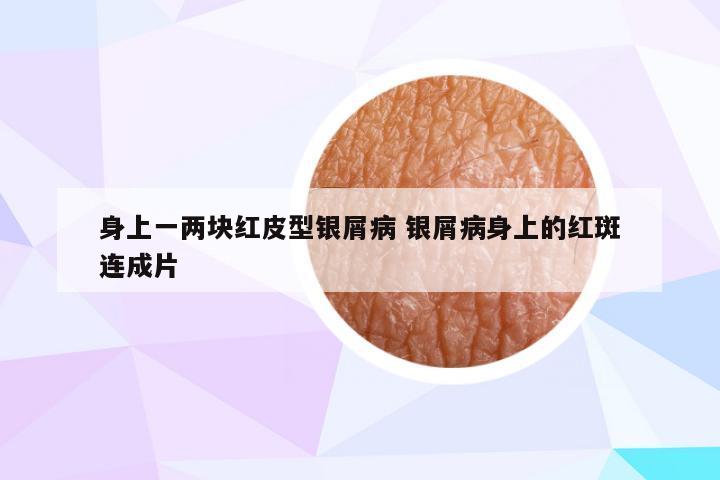 身上一两块红皮型银屑病 银屑病身上的红斑连成片